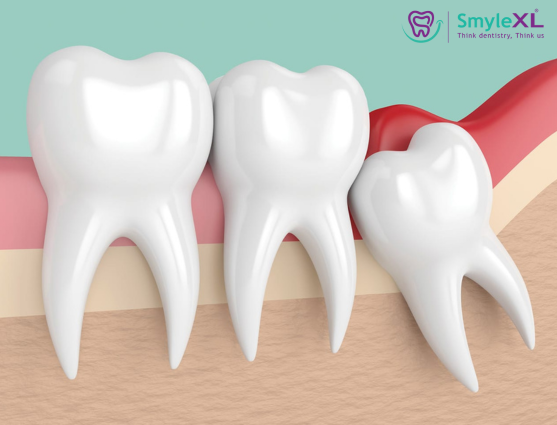 Wisdom Tooth Removal in Mumbai Central