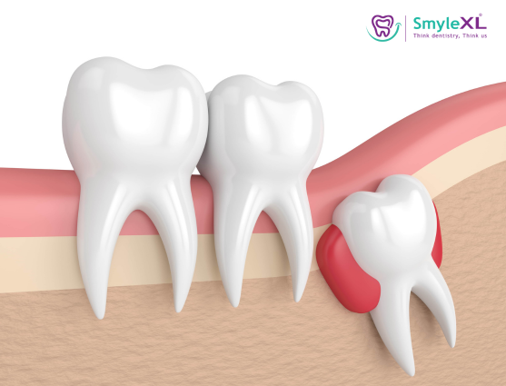 Wisdom Tooth Removal in Sinhagad Road