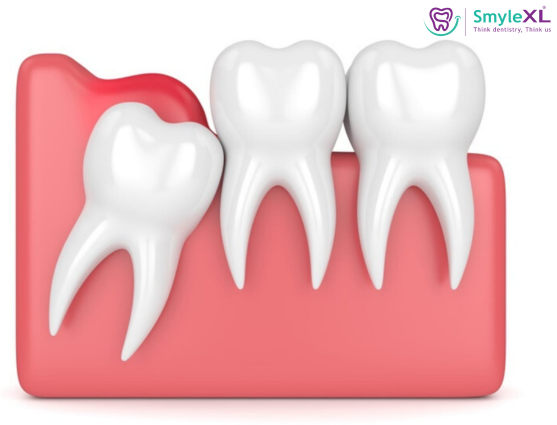 Wisdom Tooth Removal in Viman Nagar