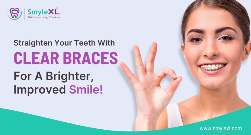 Straighten Your Teeth With Clear Braces For A Brighter, Improved Smile