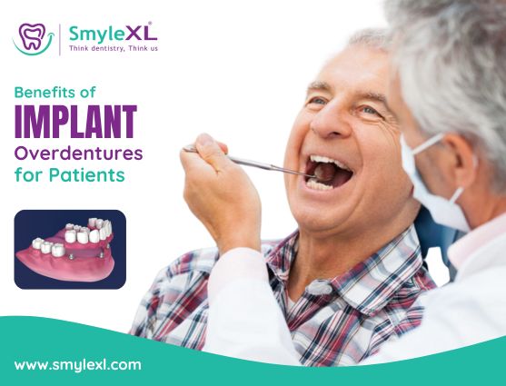 Benefits of Implant Overdentures For Patients