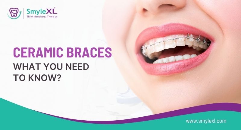 Ceramic Braces: What You Need to Know