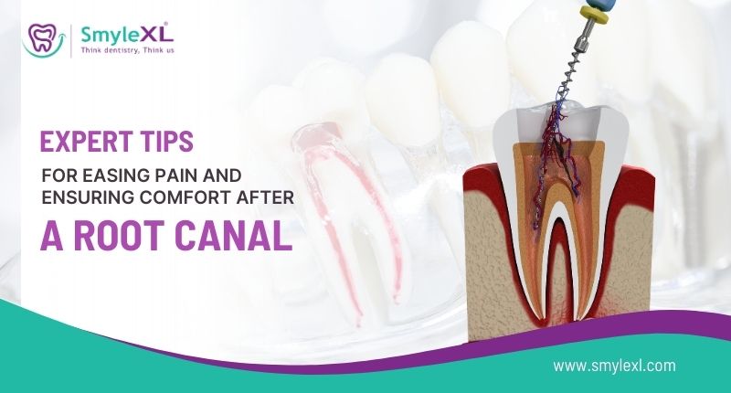 Expert Tips for Easing Pain and Ensuring Comfort After a Root Canal