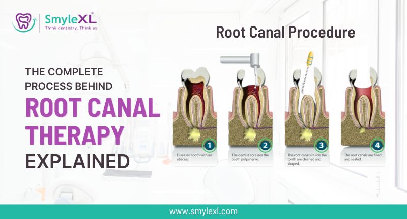 The Complete Process Behind Root Canal Therapy Explained