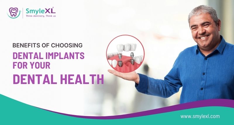 Benefits of Choosing Dental Implants for Your Dental Health