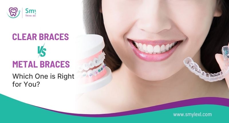 Clear Braces vs Metal Braces: Which one is right for you