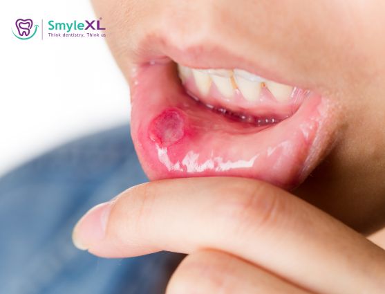 Mouth Ulcer Treatment in Viman Nagar