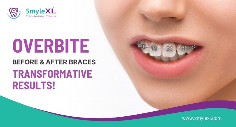 Overbite Before and After Braces: Transformative Results