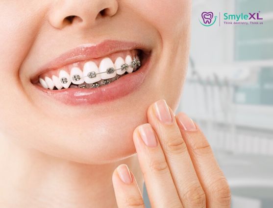 Braces Treatment in Ahmednagar