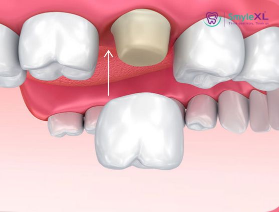 Crown and Bridge Treatment in Kondhwa