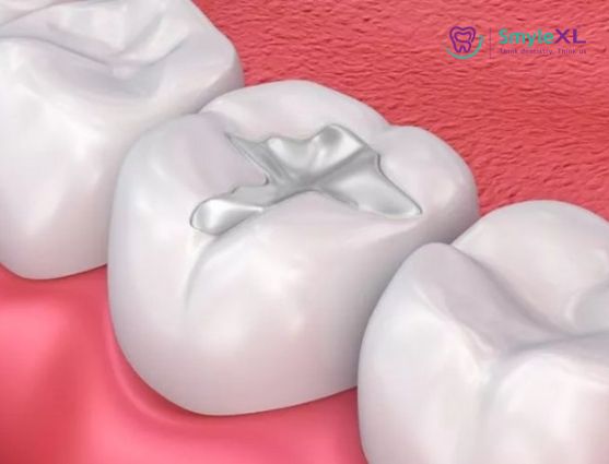Dental Fillings Treatment in Kondhwa
