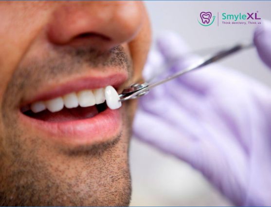 Dental Veneers Treatment in Ahmednagar