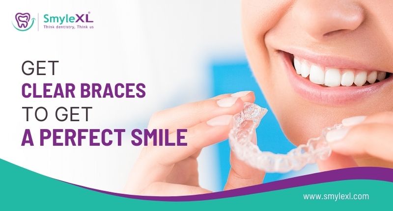 Get Clear Braces to Get a Perfect Smile