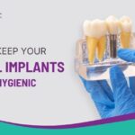 How to Keep Your Dental Implants Clean and Hygienic