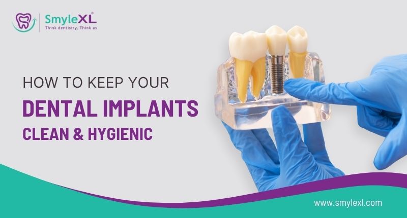 How to Keep Your Dental Implants Clean and Hygienic