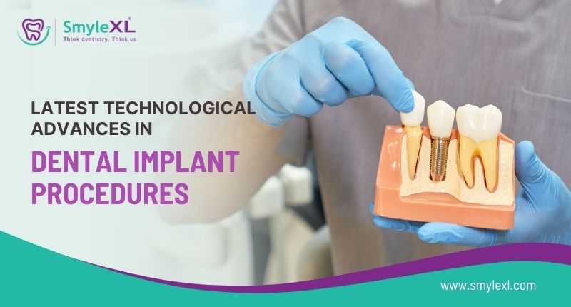 Latest Technological Advances in Dental Implant Procedures