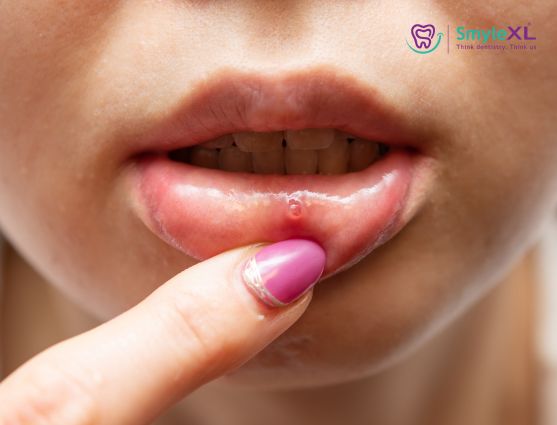 Mouth Ulcer Treatment in Ahmednagar