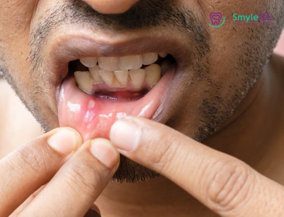 Mouth Ulcer Treatment in Kondhwa