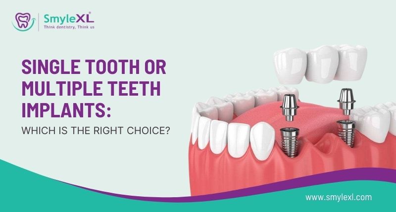 Single Tooth or Multiple Teeth Implants: Which is the Right Choice?