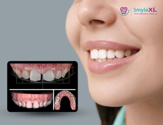 Smile Designing Treatment in Kondhwa
