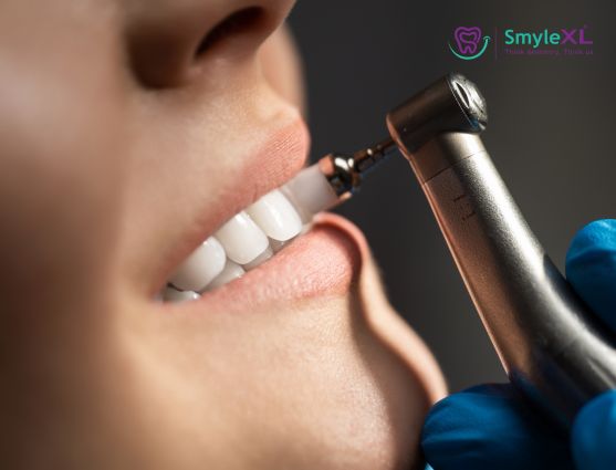 Teeth Whitening Treatment in Ahmednagar