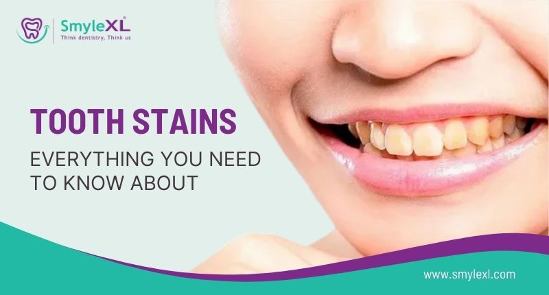 Tooth Stains – Everything You Need to Know About