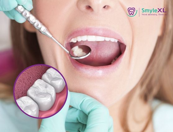 dental fillings treatment in vijay nagar