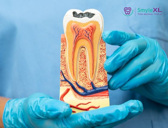 root canal treatment in vijay nagar