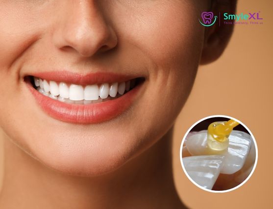 Dental Veneers Treatment in Kolhapur