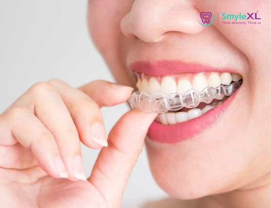 Invisible Braces Treatment in Kolhapur