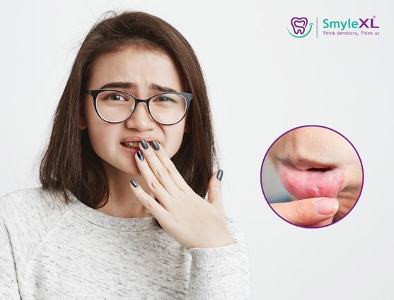 Mouth Ulcer Treatment in Dwaraka Nagar