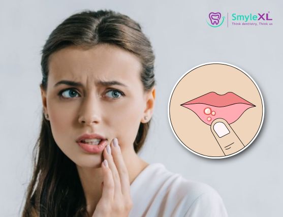 Mouth Ulcer Treatment in Mumbai Central