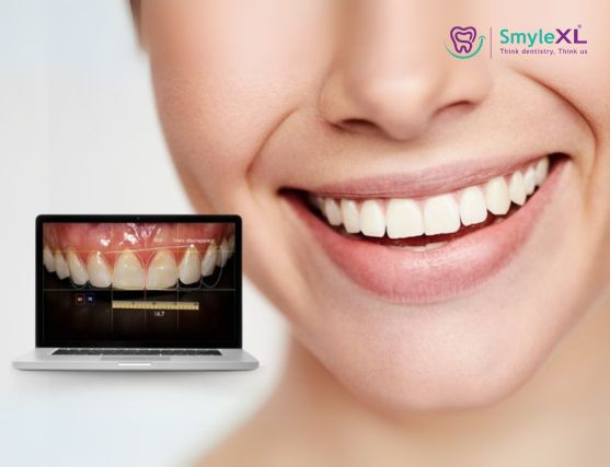 Smile Designing Treatment in Sarthana Jakat Naka Surat