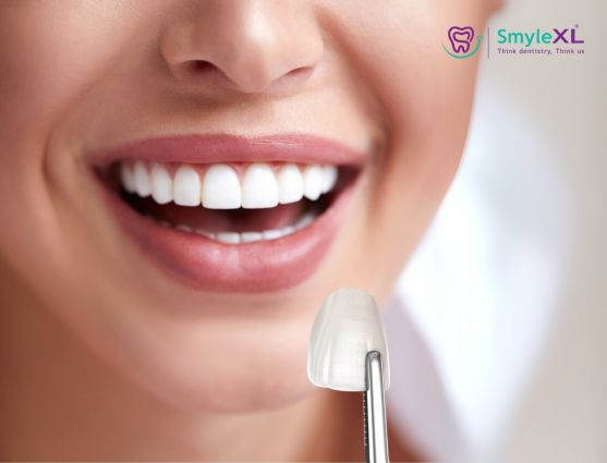 Dental Veneers Treatment in Nallagandla