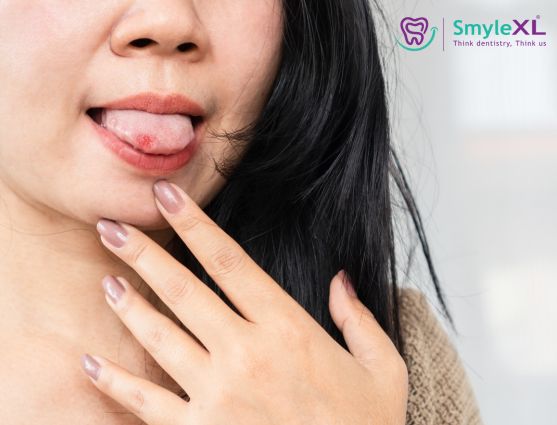 Mouth Ulcer