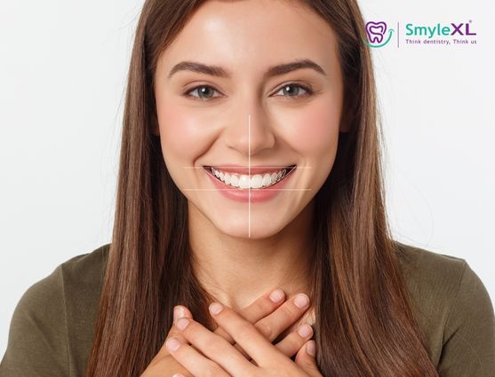 Smile Designing Treatment in Nallagandla