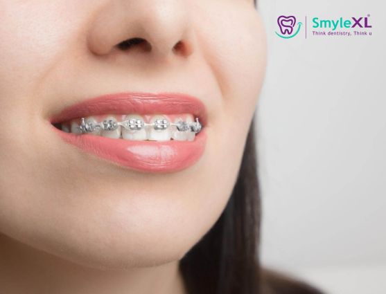 Braces Treatment in Nashik Road Nashik