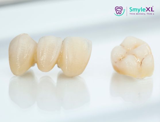 Crown and Bridge Treatment in Nashik Road Nashik