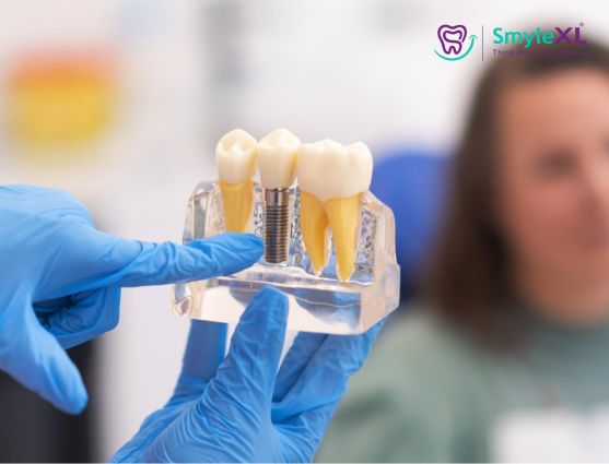 Dental Implant Treatment in Nashik Road Nashik