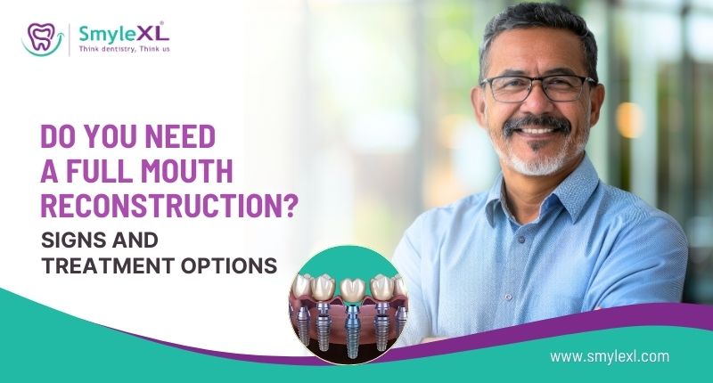 Do You Need a Full Mouth Reconstruction? Signs and Treatment Options