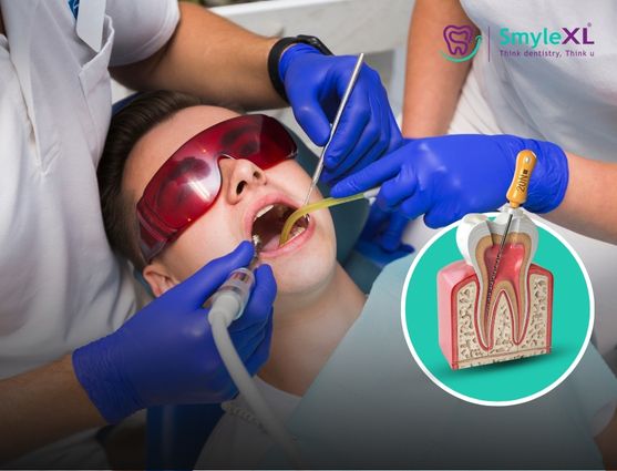 Root Canal Treatment In Lal Darwaja Surat