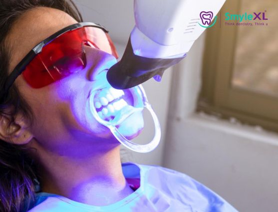 Teeth Whitening Treatment in Nashik Road Nashik