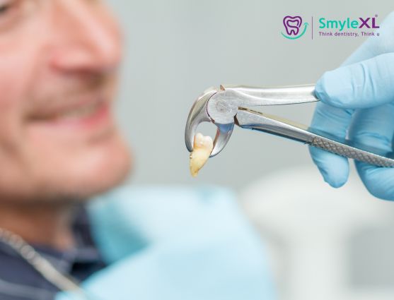 Wisdom Tooth Removal in Nashik Road Nashik
