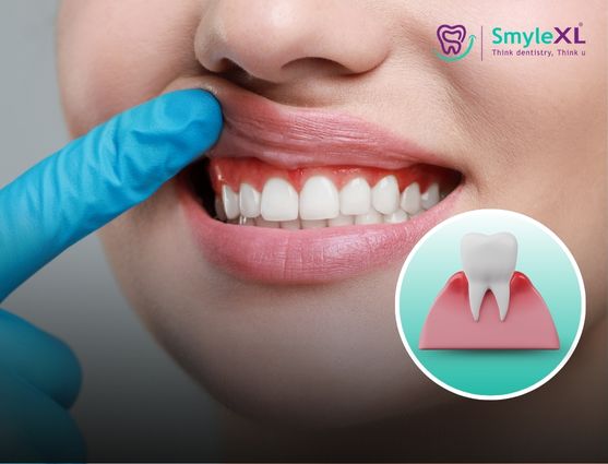 Advanced Gum Treatment in Lal Darwaja Surat
