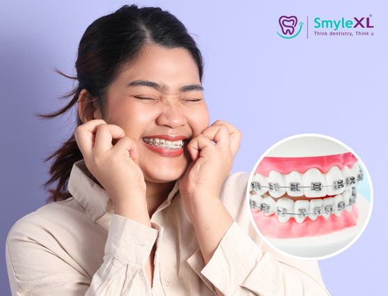 Braces Treatment in Lal Darwaja, Surat