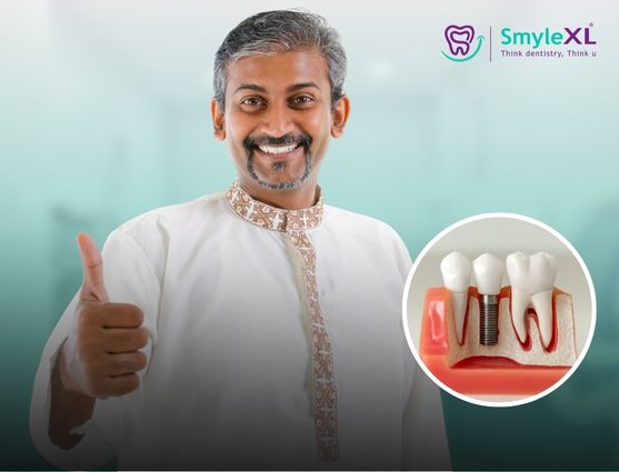 Dental Implant Treatment in Lal Darwaja Surat