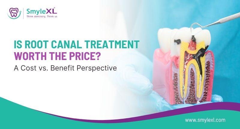 Is Root Canal Treatment Worth the Price? A Cost vs. Benefit Perspective