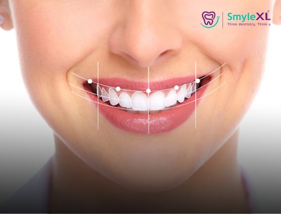 Smile Designing Treatment in Lal Darwaja Surat