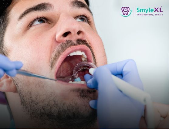 Teeth Cleaning in Lal Darwaja Surat