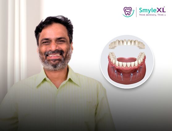 full mouth restoration in pimple nilakh